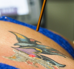 ... tattoo removal laser, tattoo removal buffalo, Trinity tattoo removal