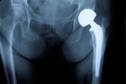 For more information about filing a defective hip replacement lawsuit, please contact Alonso Krangle LLP at 1-800-403-6191 or visit our website, http://www.FightForVictims.com