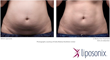 Shu Cosmetic Surgery Announces New Liposonix Non-Invasive Fat...