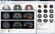 Syntermed's NeuroQ™ 3.7 for SPECT Brain Imaging Announced at RSNA
