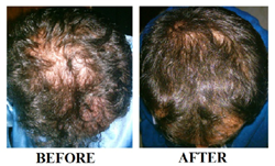 Revivogen is an all-natural topical thinning hair treatment developed by board-certified dermatologist Dr. Alex Khadavi
