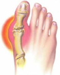 Topical BioMedics Offers Help for Those Who Suffer with Gout with Its...