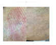 Physicians Agree That Using Dermaka Cream Reduces Redness and Bruising