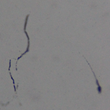 Expanded Study Confirms that Lyme Disease May Be Sexually Transmitted