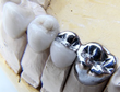 Benefits of Dental Implants vs. Bridges for Bay Area Patients...