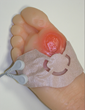 Surface Acoustic Wave Patch Therapy Affects Tissue Oxygenation in...