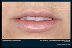 After Restylane Silk - Luscious Lips