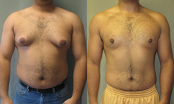 Gynecomastia