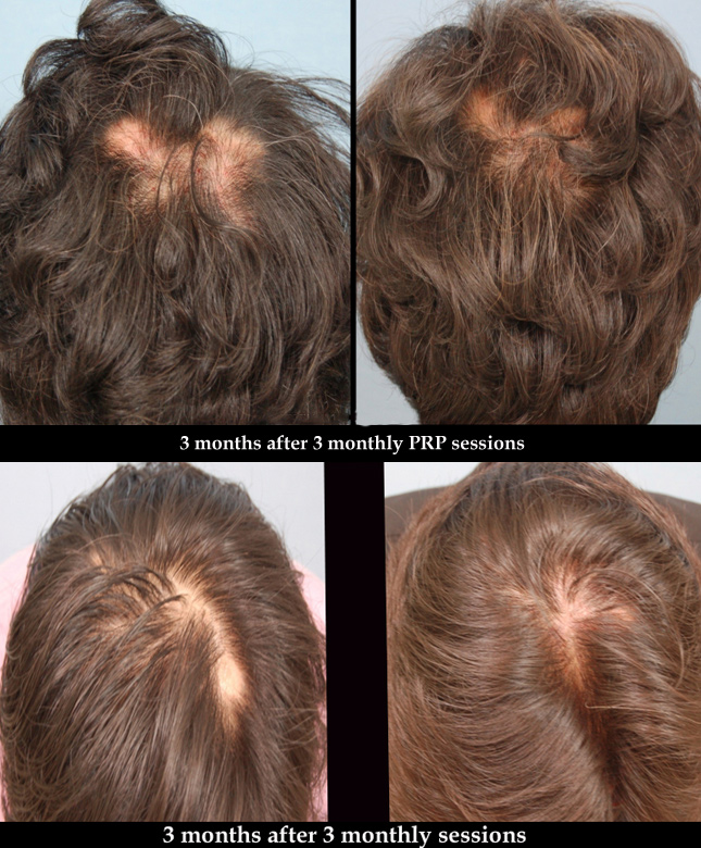 Toronto Facial Cosmetic Surgery Center Announces Innovative Hair Loss Treatment with PRP