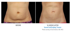 coolsculpting nj