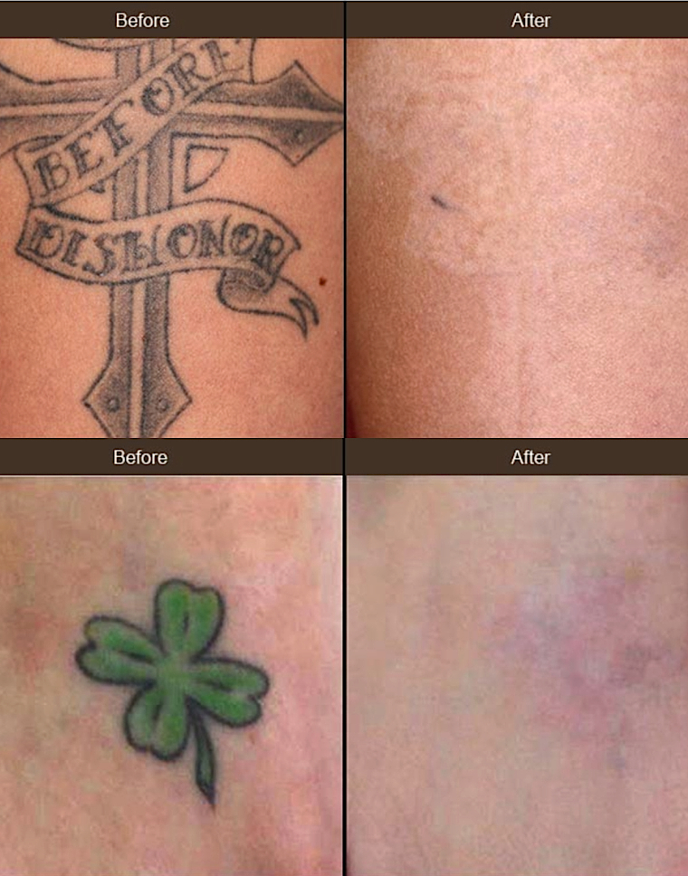 Tattoo Removal With New Laser Upgrade Comes To Beverly 