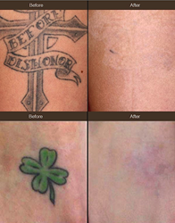 Tattoo Removal With New Laser Upgrade Comes To Beverly ...