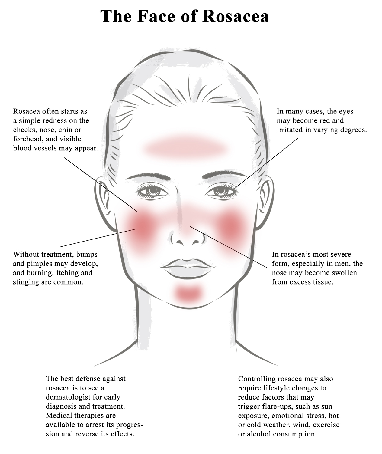 Its Becoming Clear Rosacea Awareness Month Highlights Potential