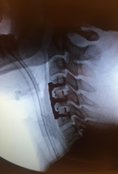 A lateral fluoro of Arena-C HA, successfully implanted.