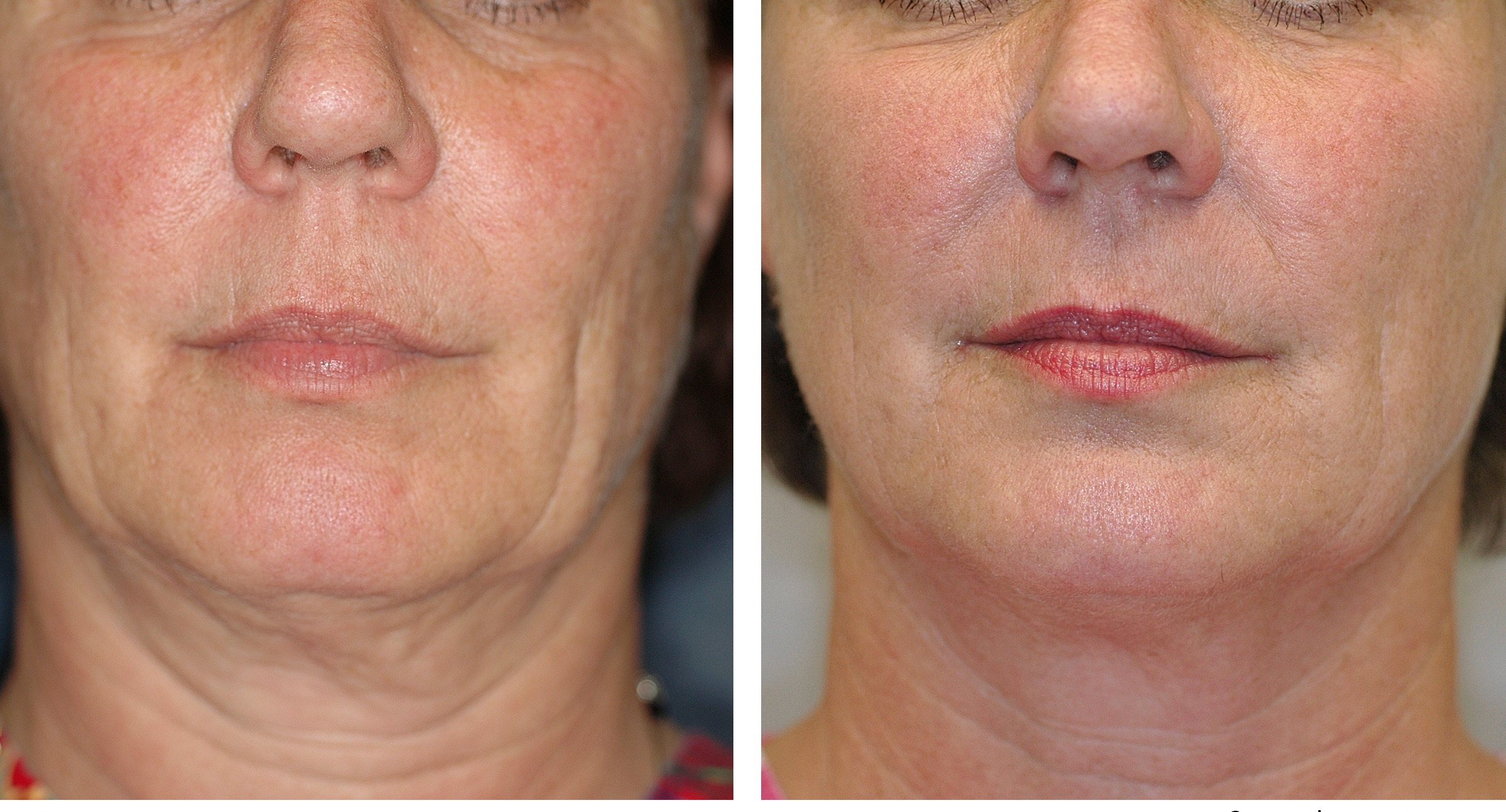 Thermage For Non Surgical Face Lifts And To Tighten Loose Skin Was The