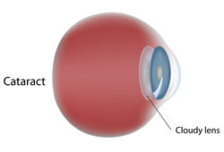 An illustration of a cataract