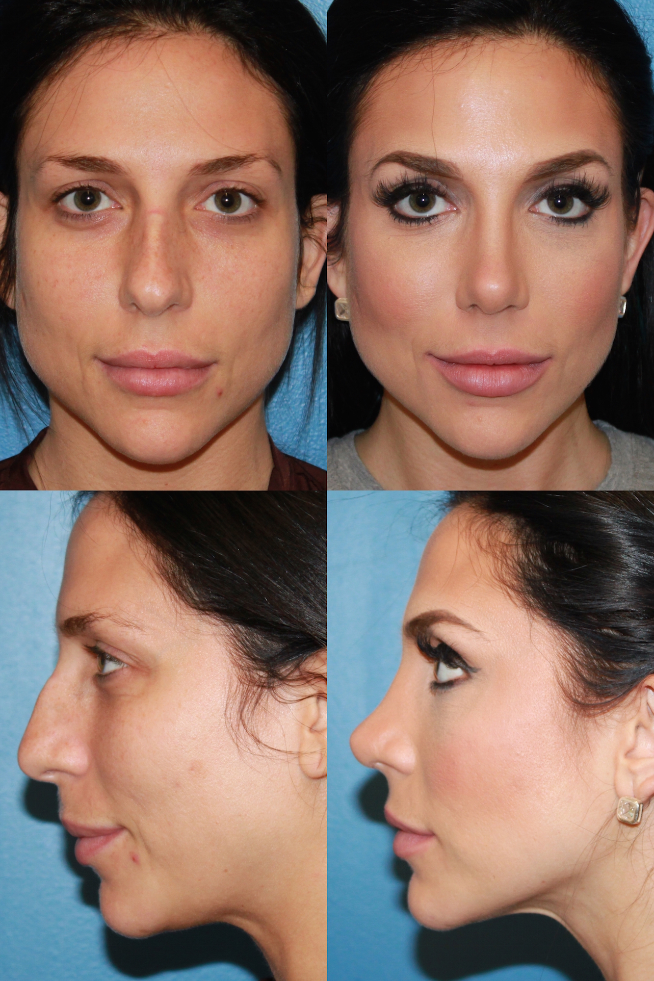 Rhinoplasty Nose Job Recovery With Rhinoplasty Specialist Dr Donald B Yoo 