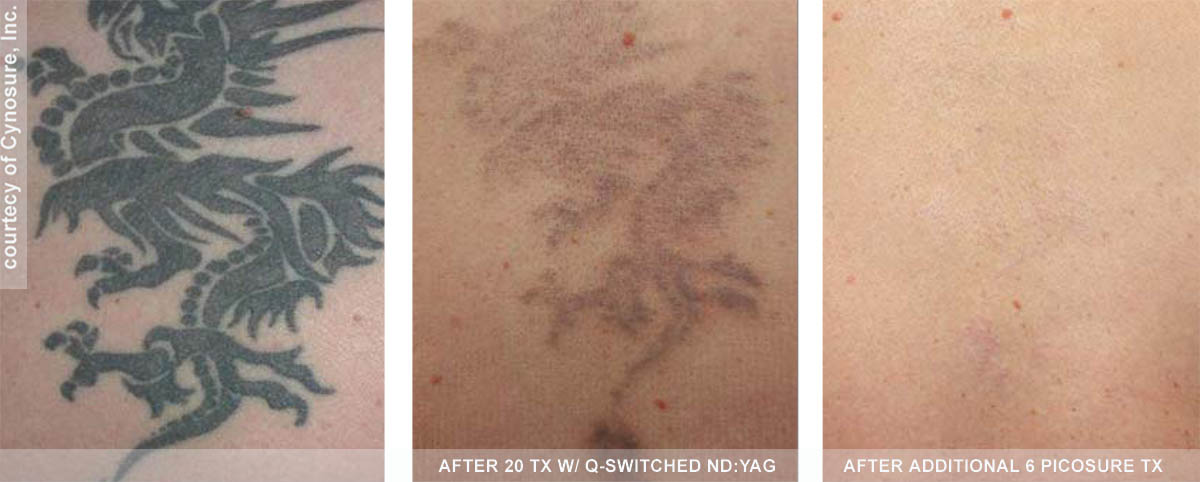 Removal of All Color Tattoos with the Upgraded Picosure ...