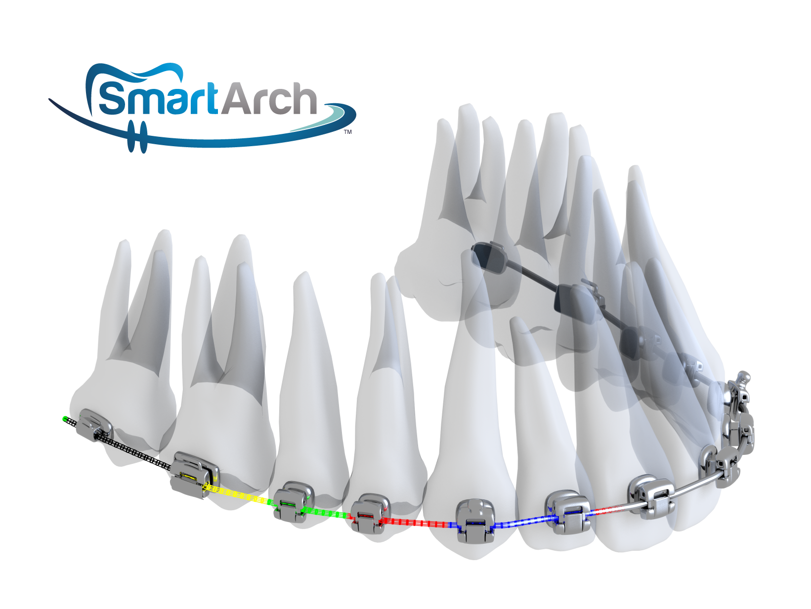 New case studies for SmartArch orthodontic archwire paves way to