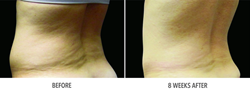 fort myers plastic surgeon CoolSculpting Plus Before & After
