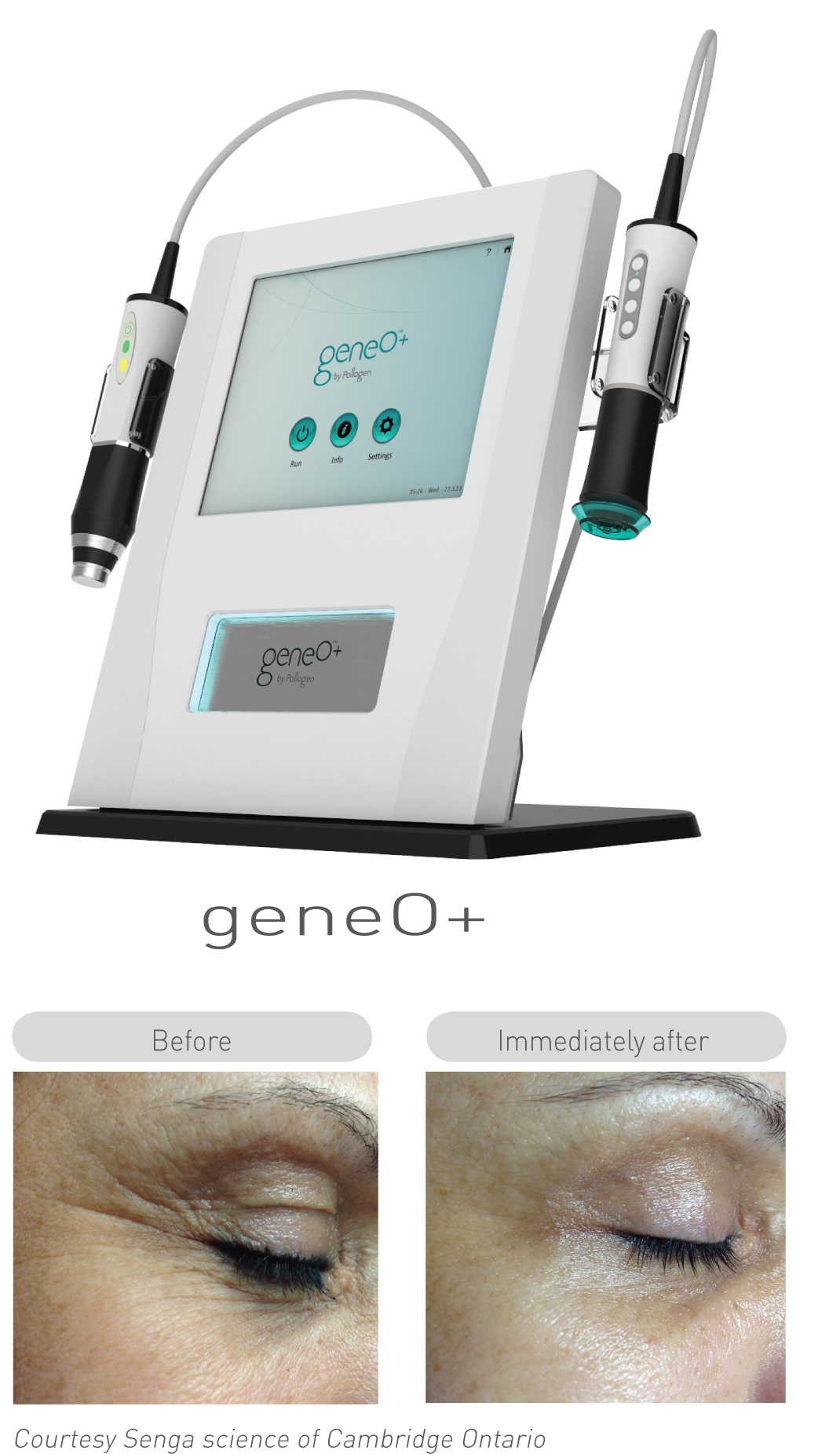 Spa Diva Now Offers Pollogen Oxygeneo 3 In 1 Super Facial Treatments