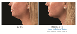 coolsculpting, double chin, cool, mini, before, after, stamford, ct