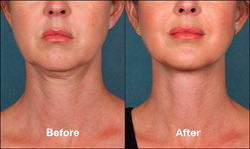 Before and After - Kybella