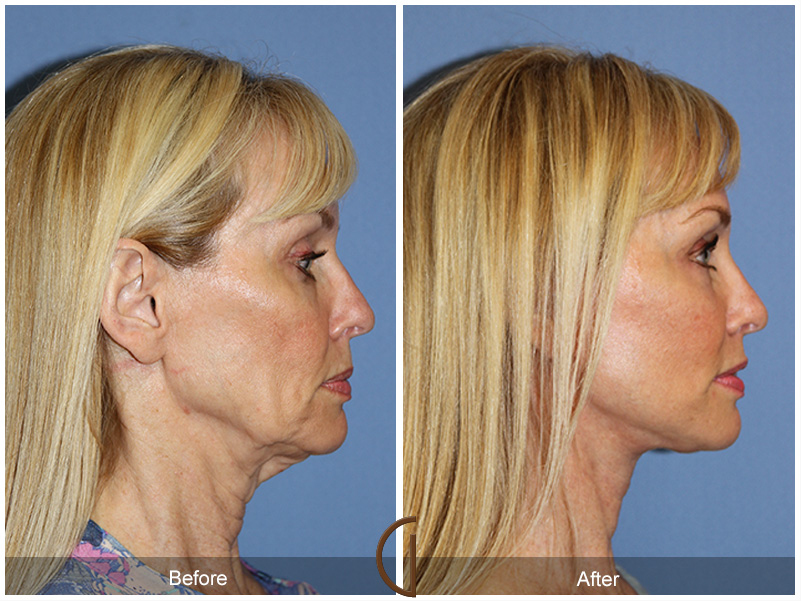 Dr. Kevin Sadati Releases Tip Sheet on Facelift vs. Neck Lift: When A