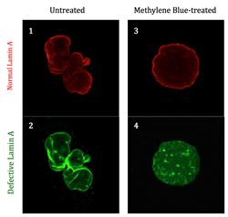 Methylene blue repaired progeria-related defects in human cells. Untreated nuclei (left) show abnormal shape. Methylene blue-treated nuclei (right) show normal, rounded shape. Image: Kan Cao