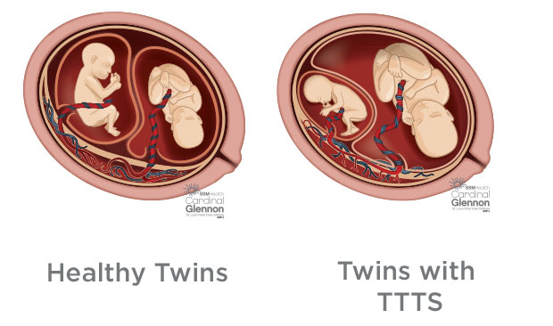 mothers-pregnant-with-twins-need-to-be-aware-of-twin-to-twin