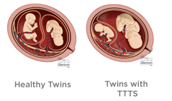 Mothers Pregnant With Twins Need To Be Aware Of Twin To Twin ...