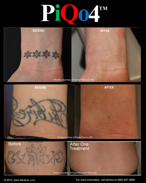 Tattoo Removal With Less Pain 40 Fewer Treatments And Clearance Of 