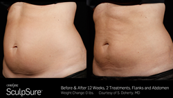 Before & After SculpSure Treatment