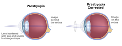 An illustration showing how presbyopia affects vision