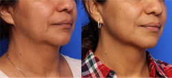 Infini Treatment Before and After