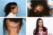 Before and After Photos of Dr. Bauman’s Traction Alopecia and Central Centrifugal Alopecia (CCCA) patient “Ivory,” treated with FUE/FUT hair transplant and a CNC 3D-Printed Hair & Scalp Prosthetic