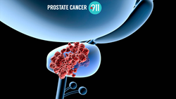 Genetic Testing For Prostate Cancer;Prostate Cancer;Dr. David Samadi