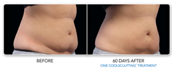 Toronto coolsculpting canada
