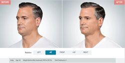 Men are taking advantage of Kybella for a refreshed, younger look.