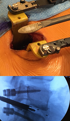 PLIFT Implant with Bone Graft and Fluoroscopy of Implant and Inserter