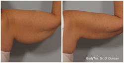 RFAL is an incredibly effective tool in fighting unwanted fat.