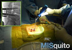 SpineFrontier, Inc's MISquito Percutaneous Pedicle Screw System