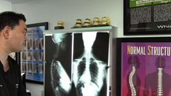 Gonstead Chiropractic Xray analysis by Dr. Ryan Suh