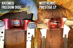 Side by side of the AxioMed Freedom Disc and the Medtronic Prestige LP disc