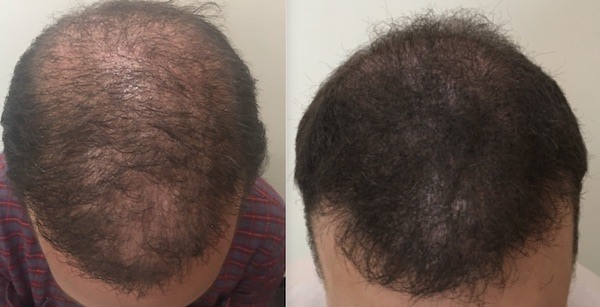 Los Angeles Hair Transplant Doctor Announces A Novel Non Surgical 