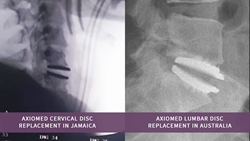 AxioMed Freedom disc deemed revolutionary by surgeons around the world
