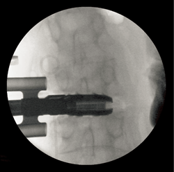 AxioMed announces the release of its lateral TDR at NASS 2017.