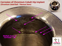 Picture showing a removed hip implant (explant) with corrosion of the chromium cobalt component