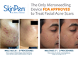 SkinPen® Precision System is a microneedling device and accessories intended to be used as a treatment to improve the appearance of facial acne scars in adults aged 22 years or older.