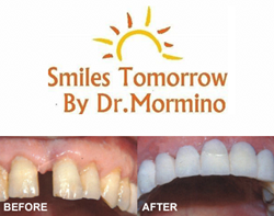 Before and After Smiles Tomorrow